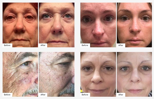 Before and After Real Result images for Age IQ Night Cream